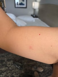 Tick bites on right arm.
