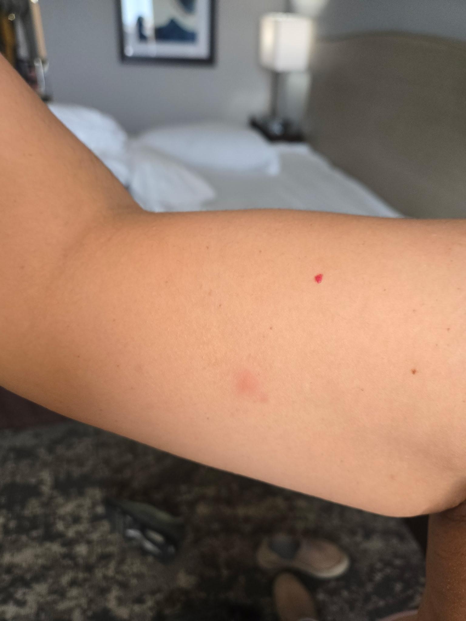 Tick bites on right arm.