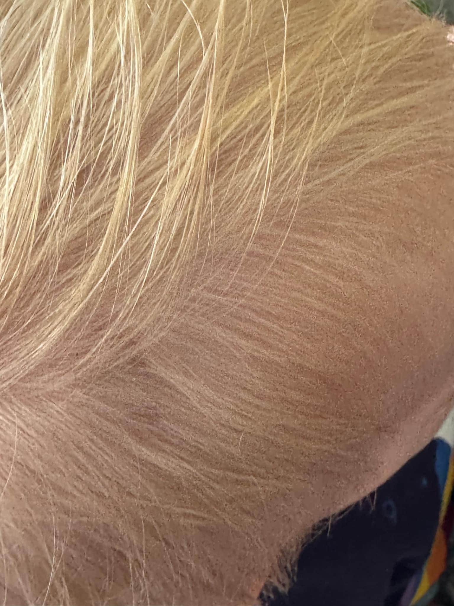Bruise head from falling door