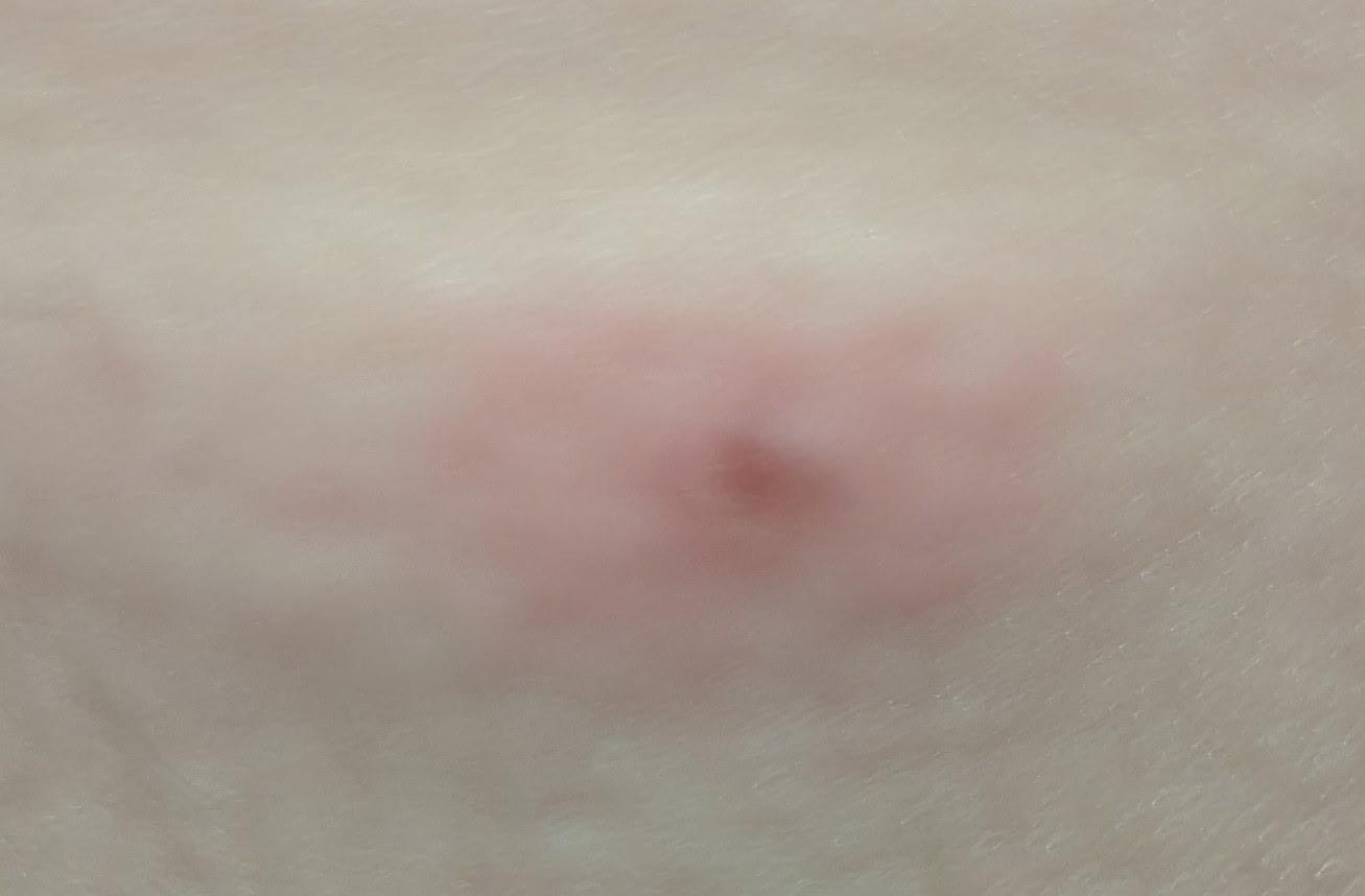 Bed bug bites! 6 in 1 night.