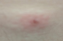 Bed bug bites! 6 in 1 night.