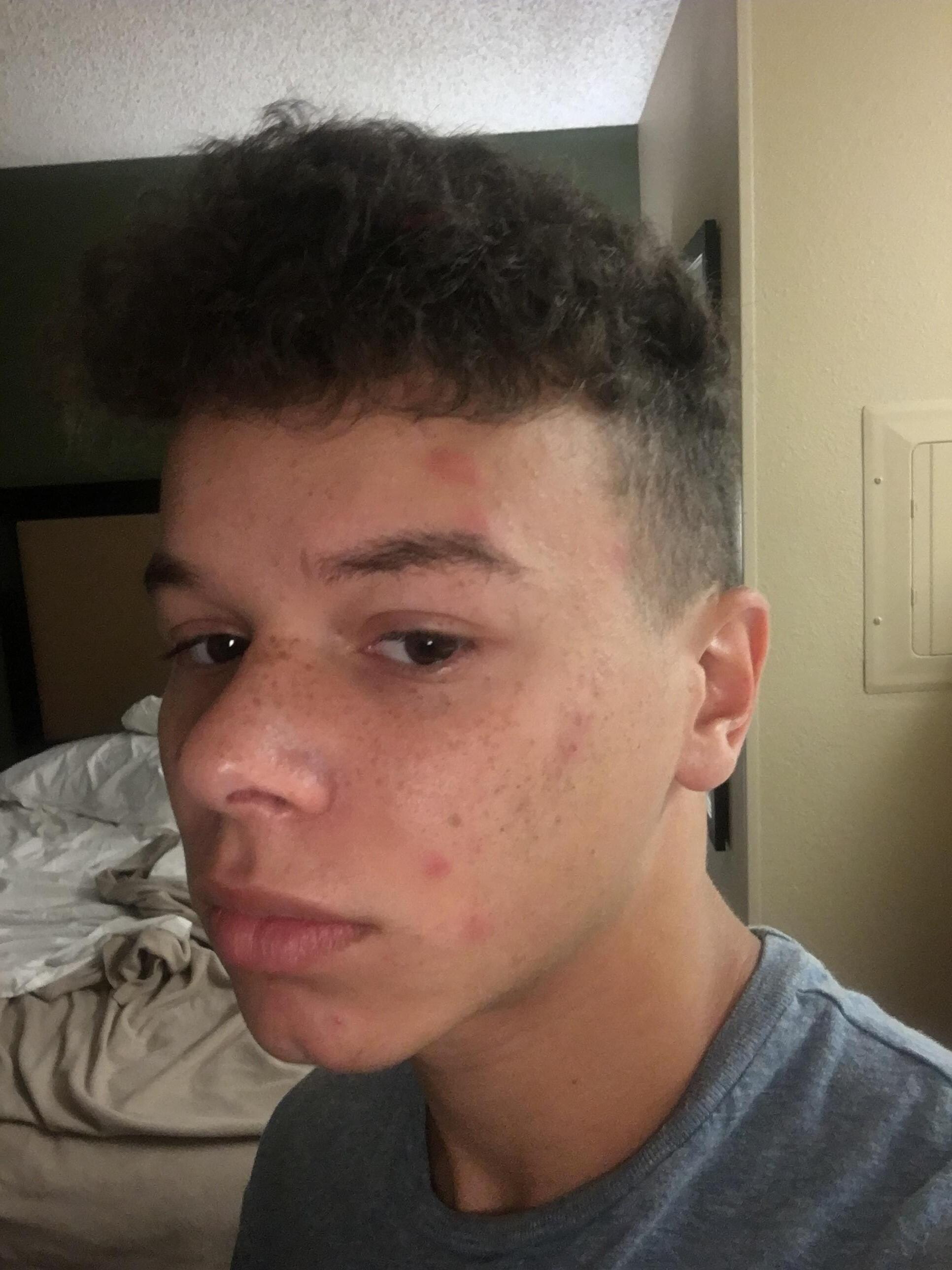 That's not acne. Bed bug bites on his face!