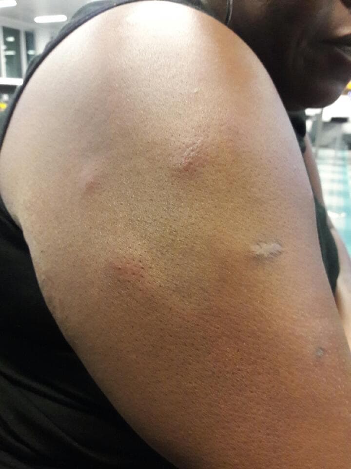 Bed Bug Bites