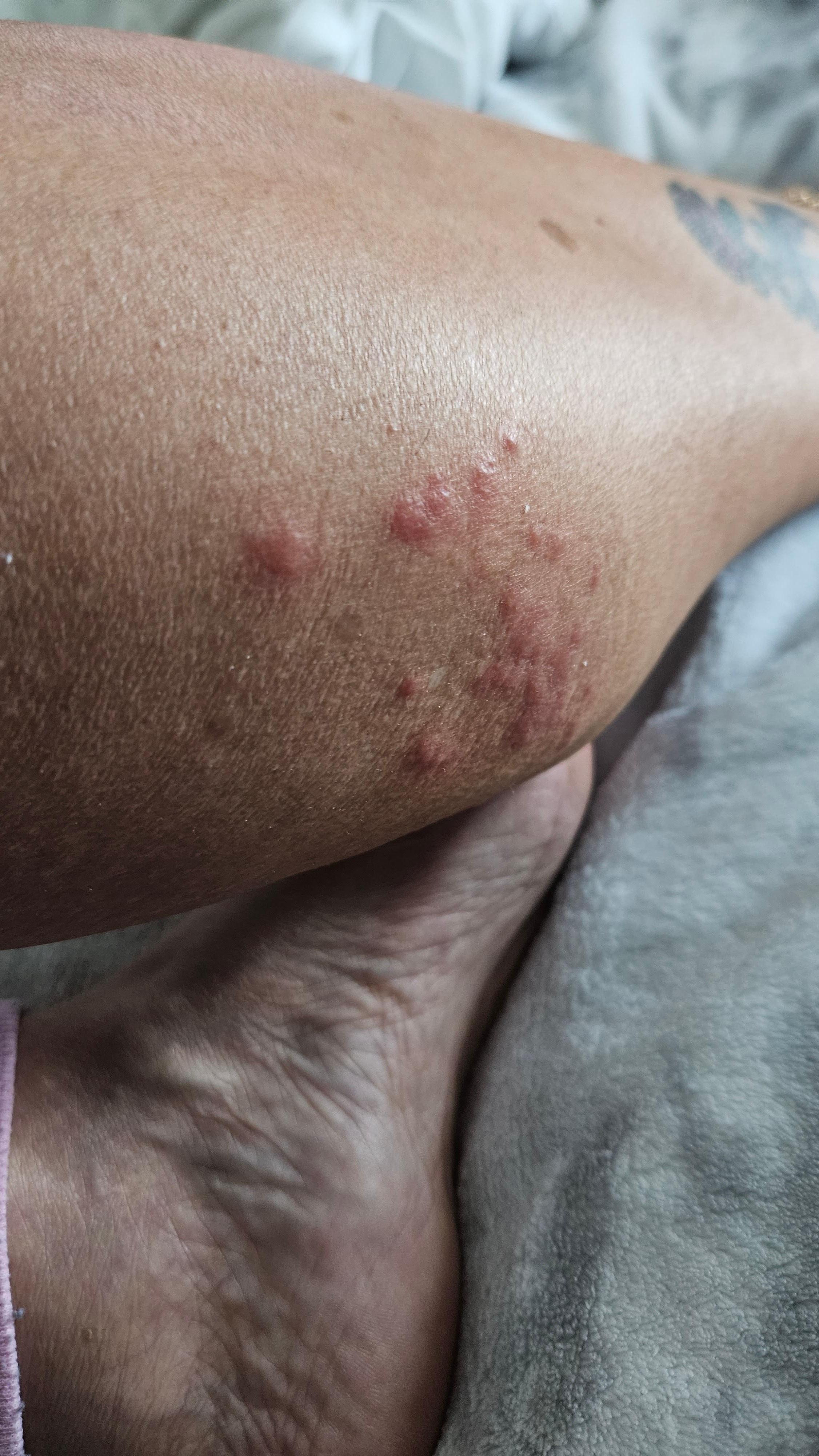 Bed bugs bites 