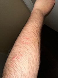 Left arm bug bites.