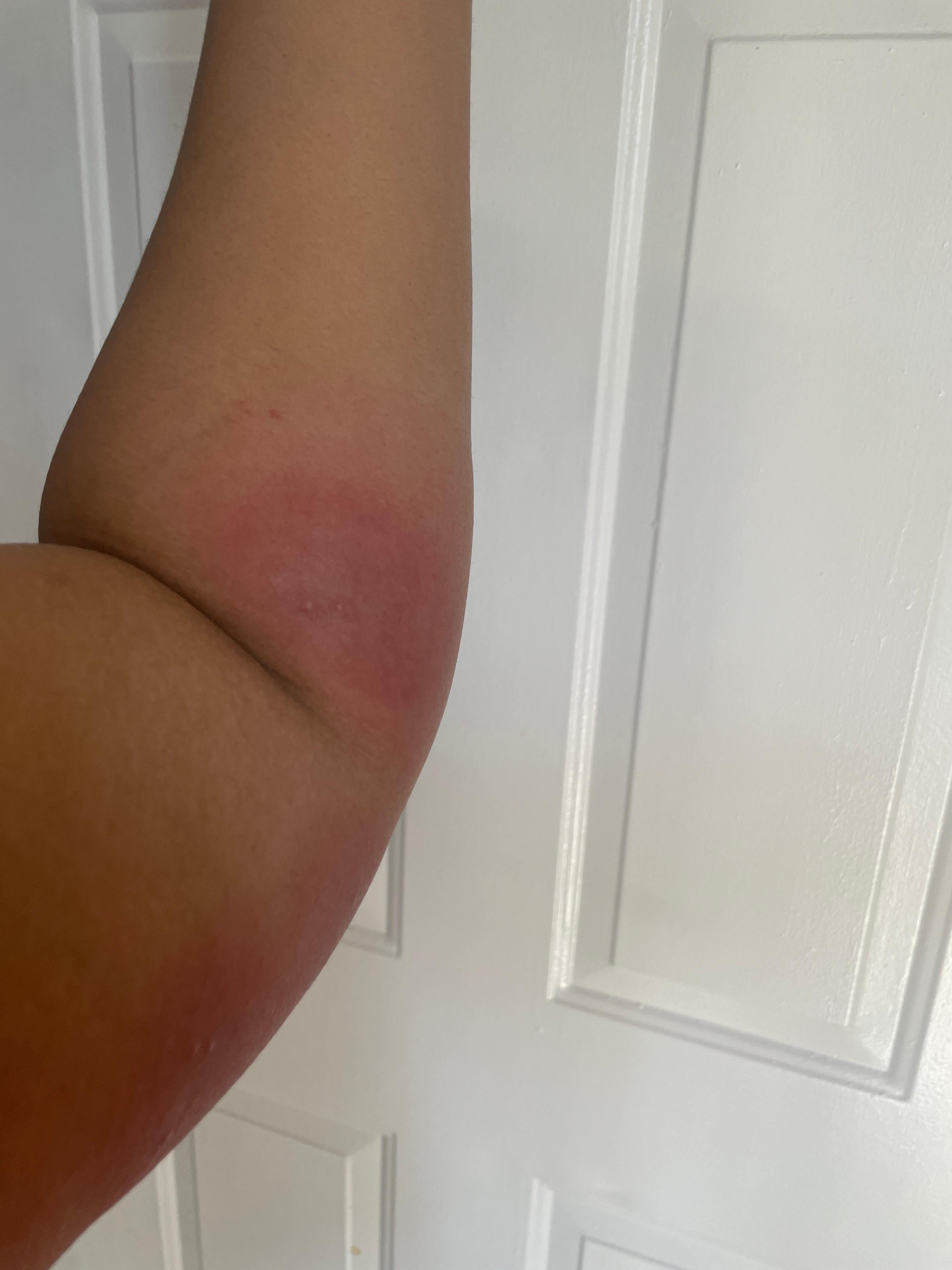 Bed Bug bite me