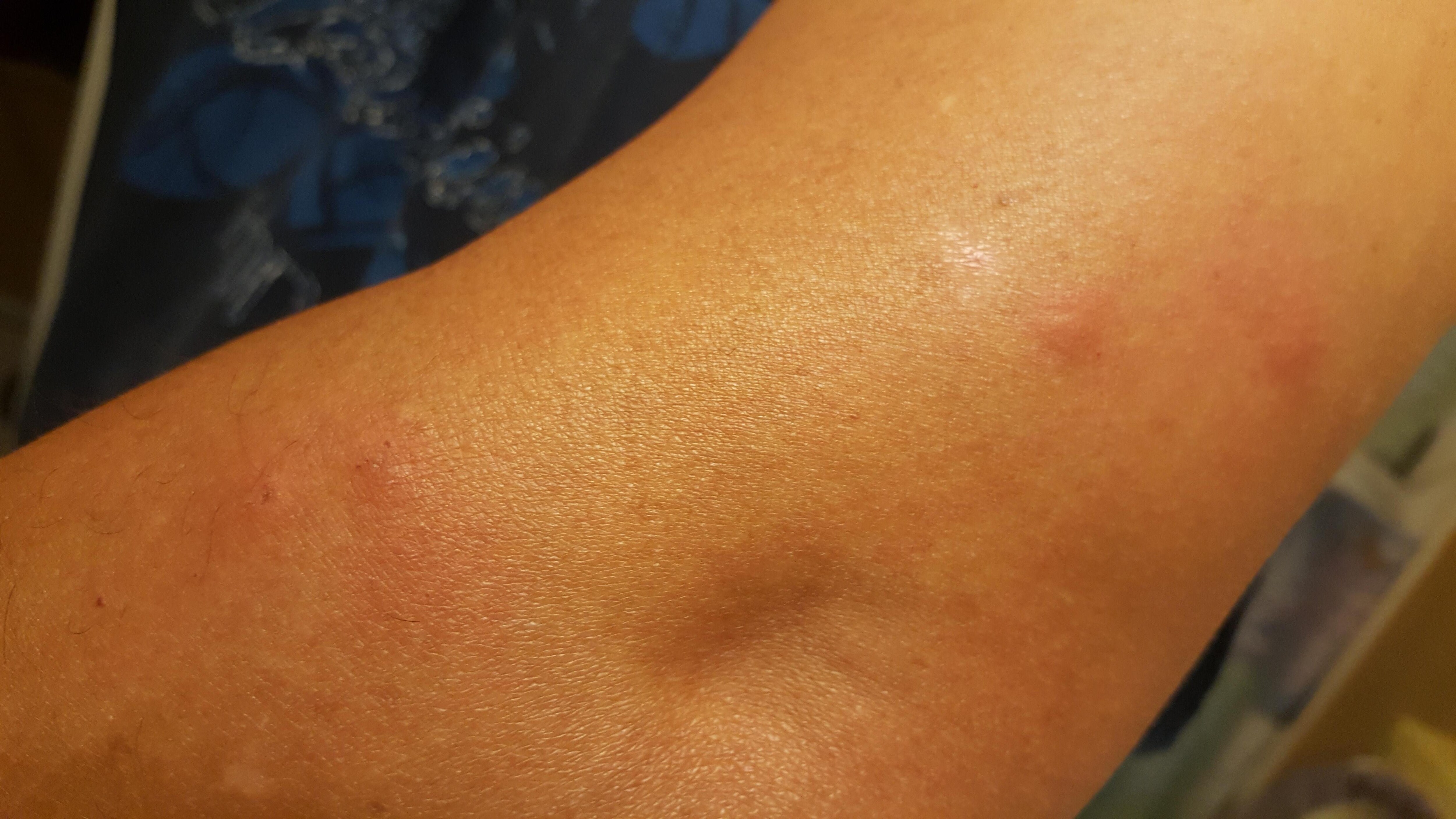 But in 4 places by bedbugs.