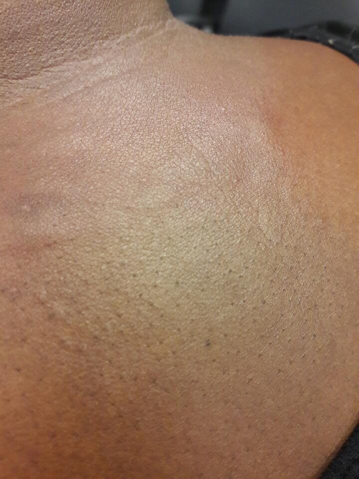 Bed Bug Bitten back