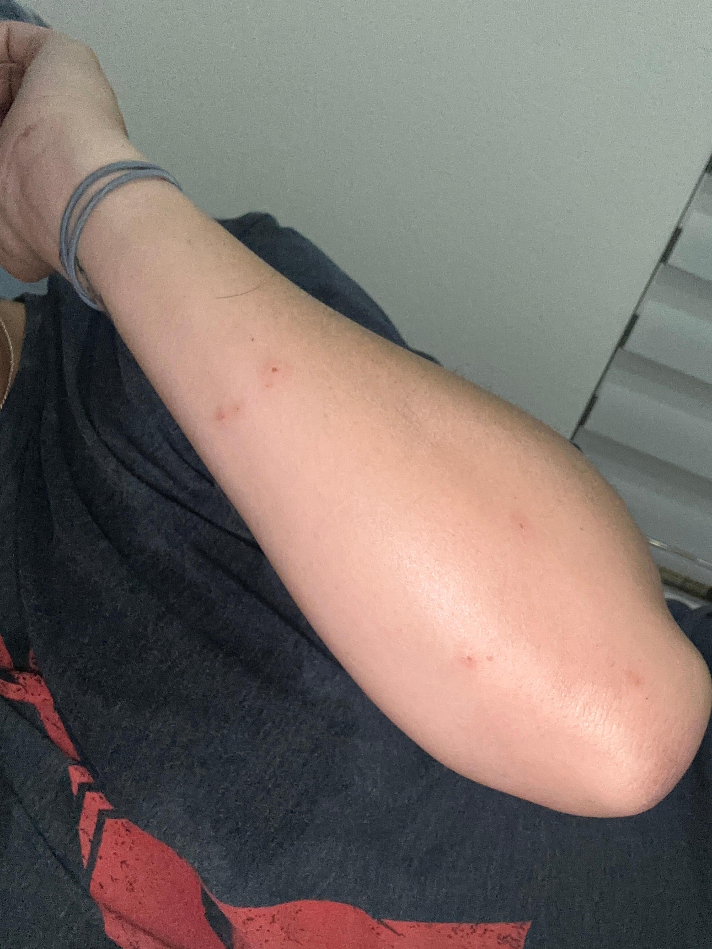 Bed bug bites