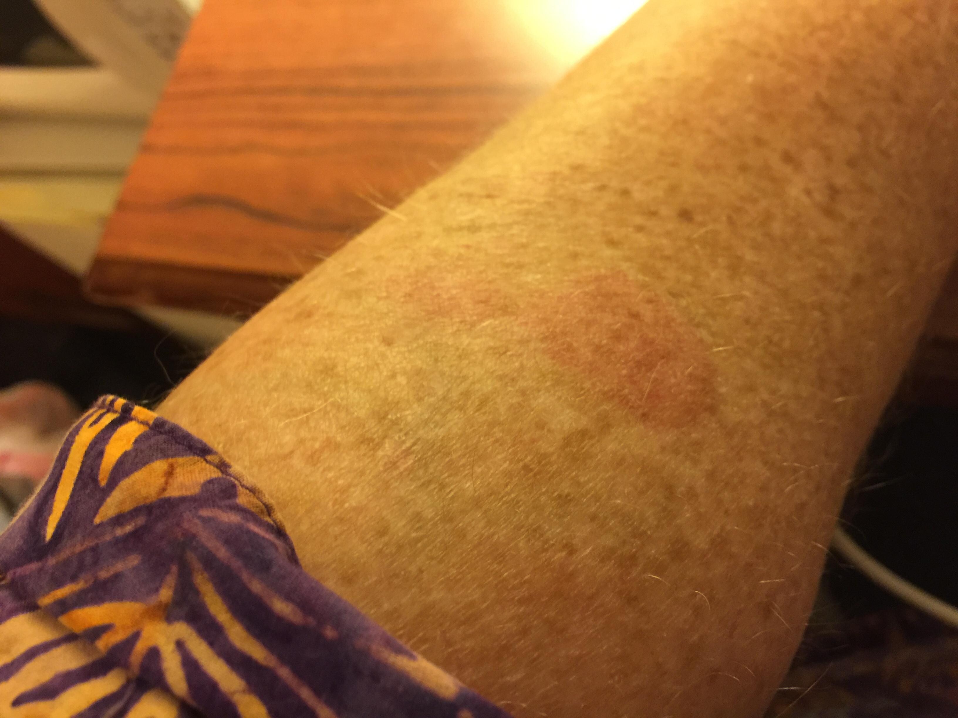 Very itchy