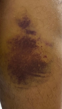 La marque mon père a eu lorsque il est tomber dans le bus