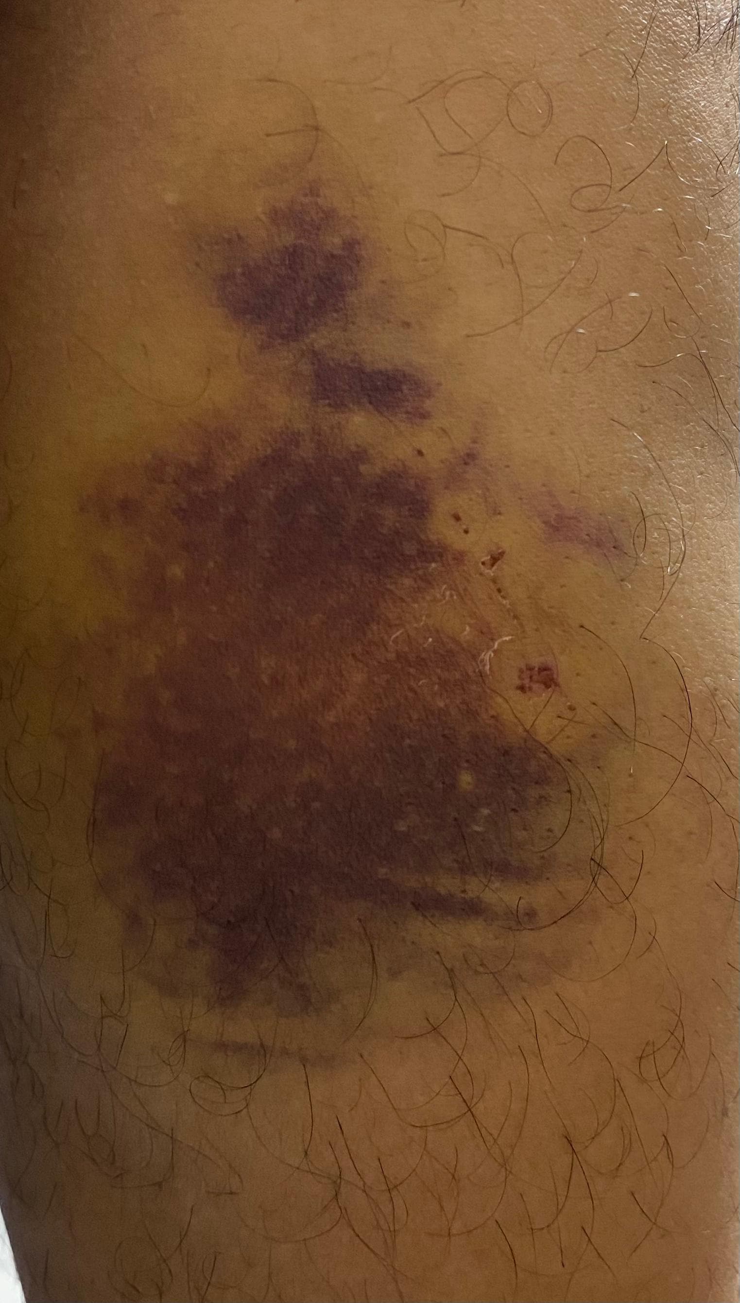 La marque mon père a eu lorsque il est tomber dans le bus