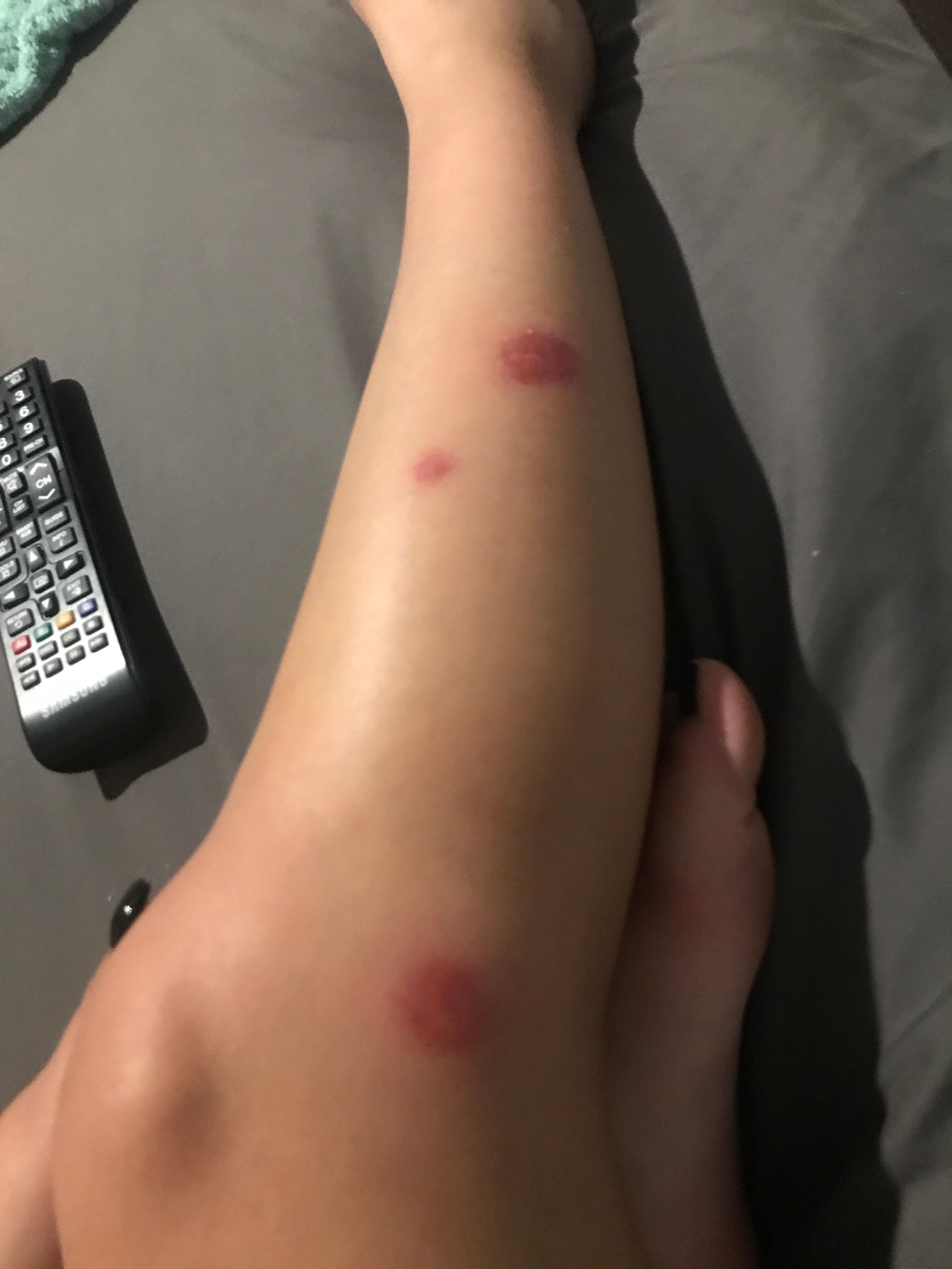 Bed bug bites