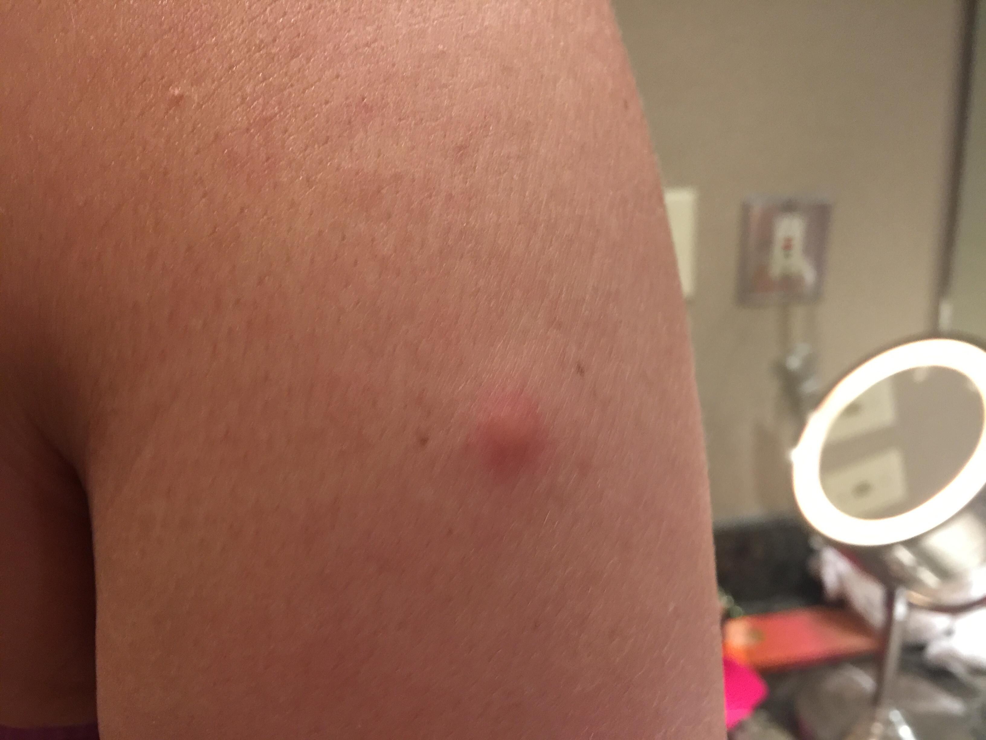 Bed bug bite