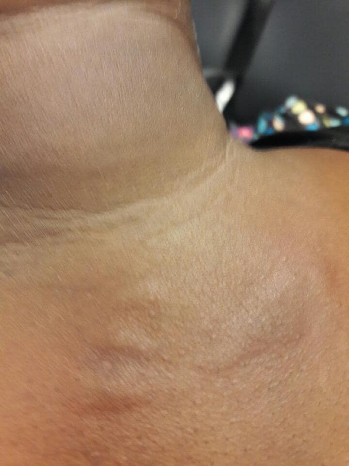 Bed Bug Bites 2