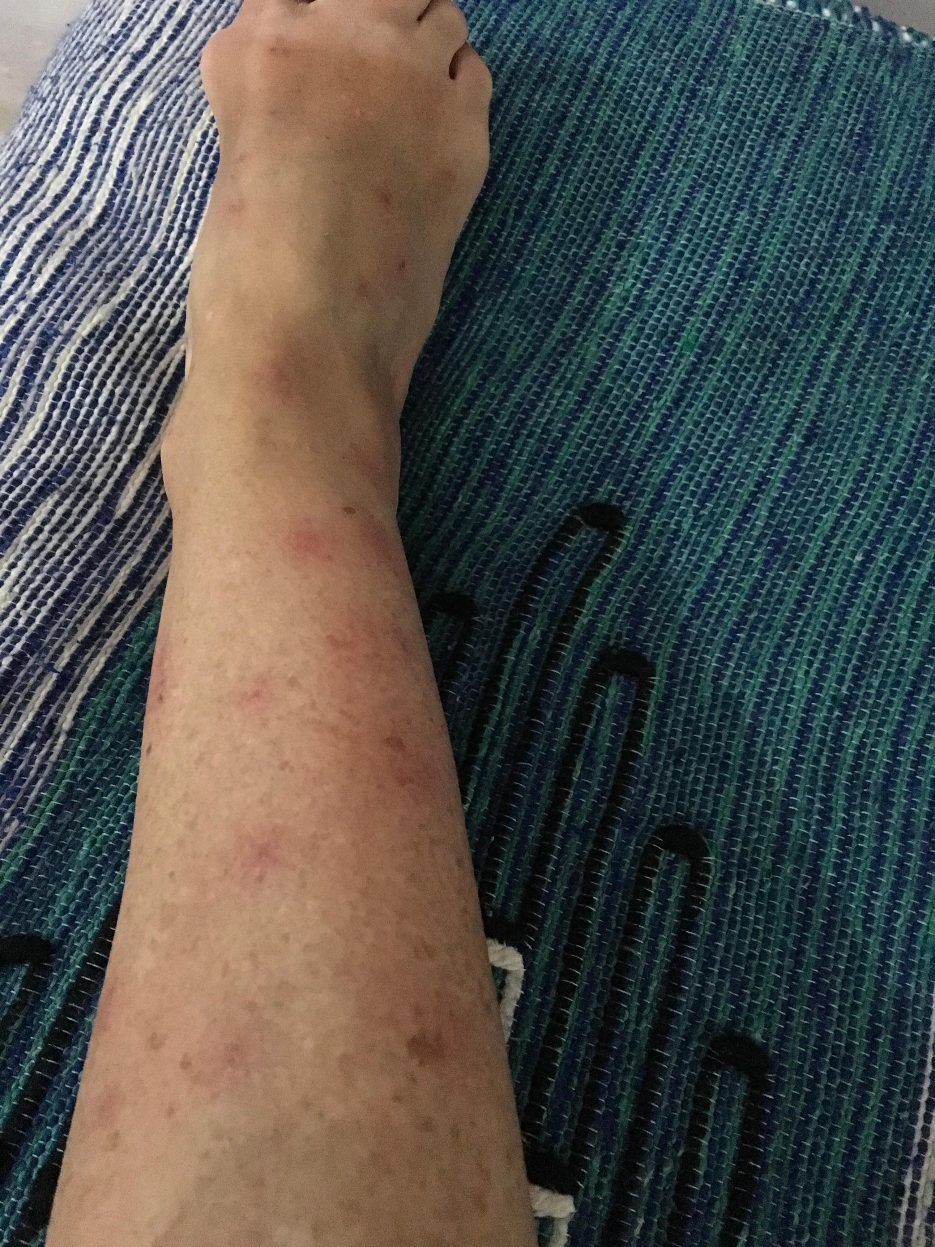 Bed bug bites