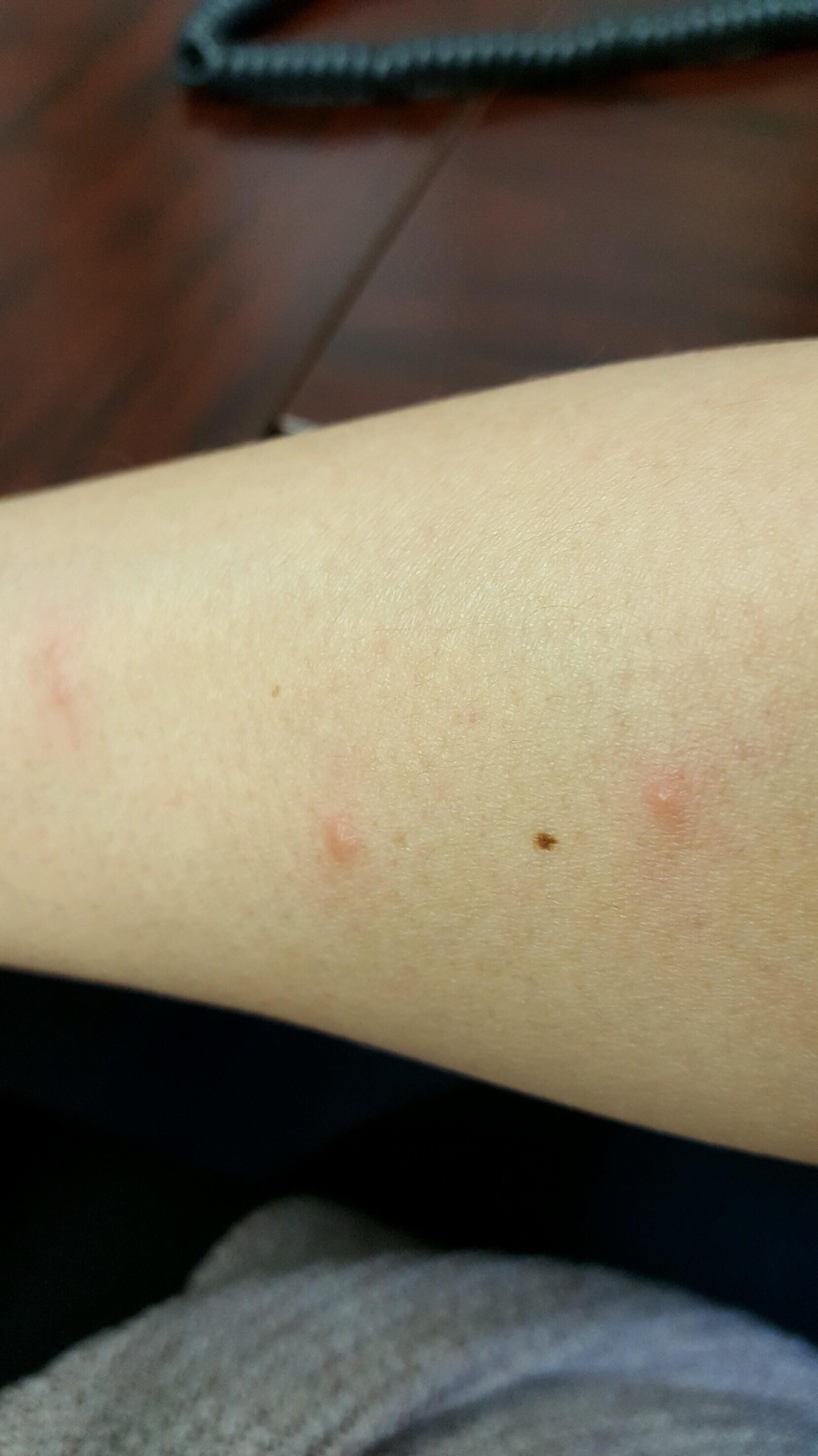 Flea / bed bug bites on arm