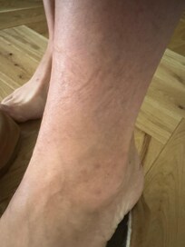 Bug bites