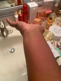 The bites on my arm. This is when I got home the sunday