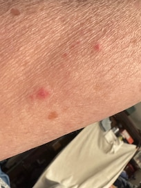 Bedbug bites