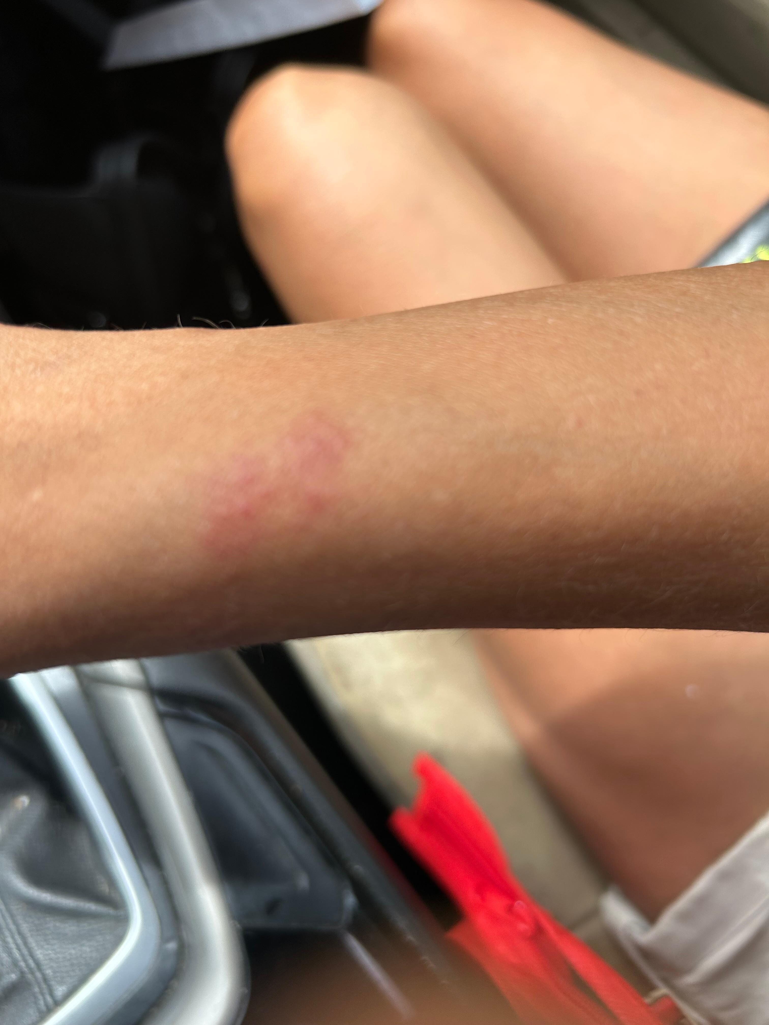 Bites