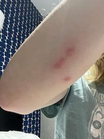 bed bugs