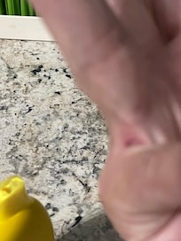 Finger cut from
Fall