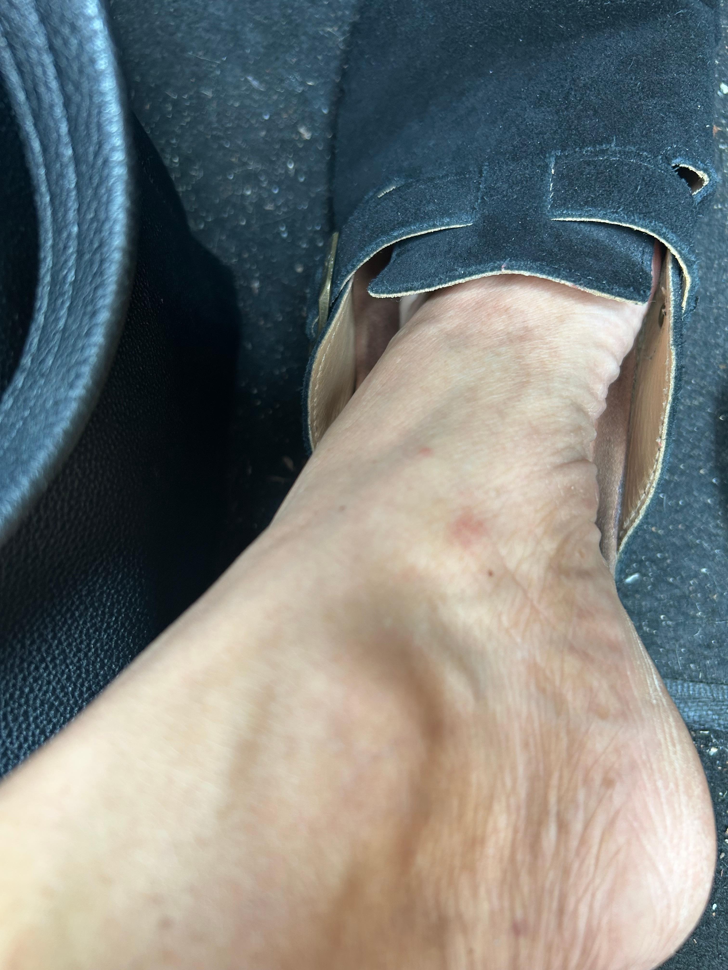 Bites