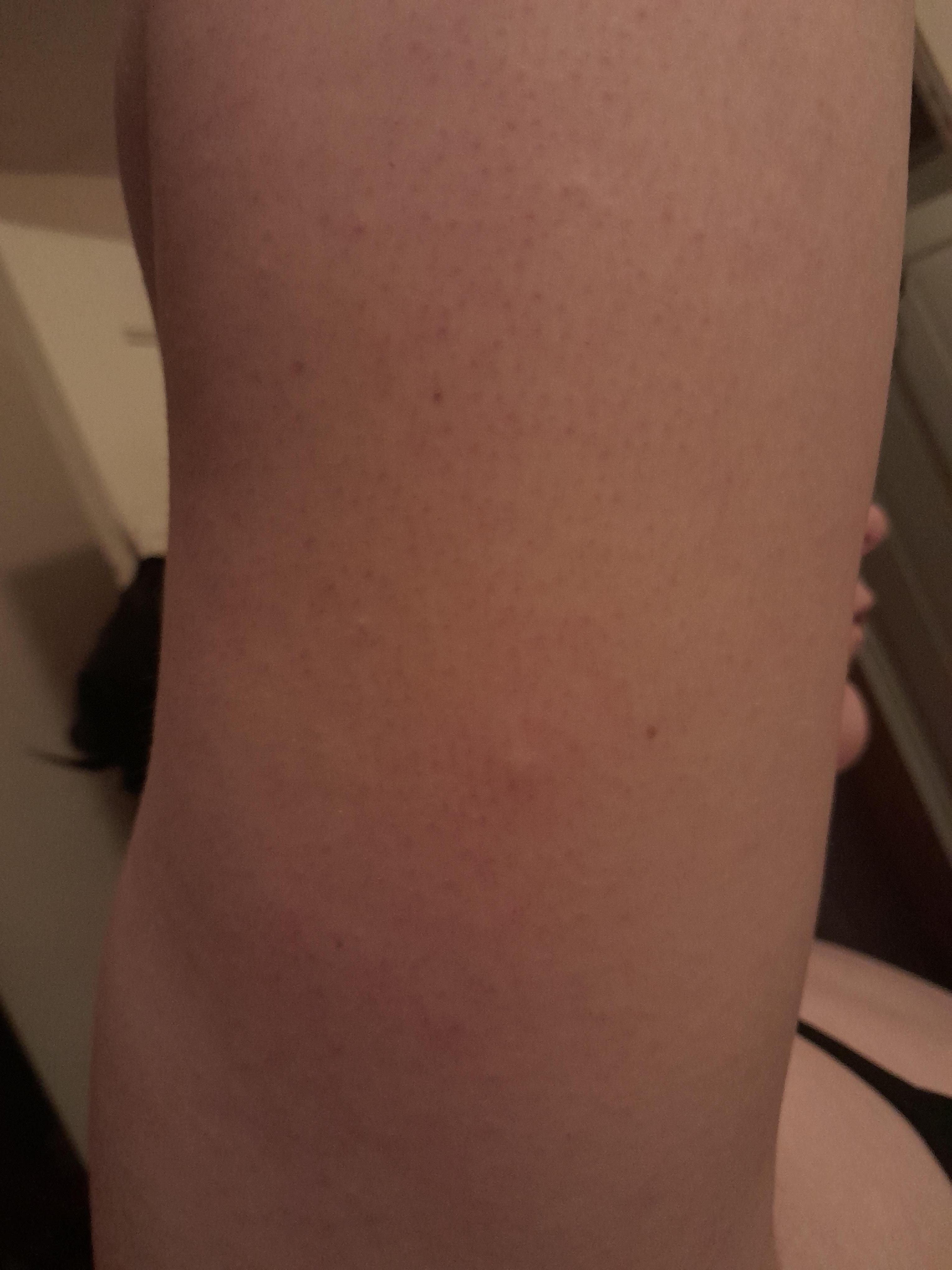 Bedbug bites from the sofa sleeper