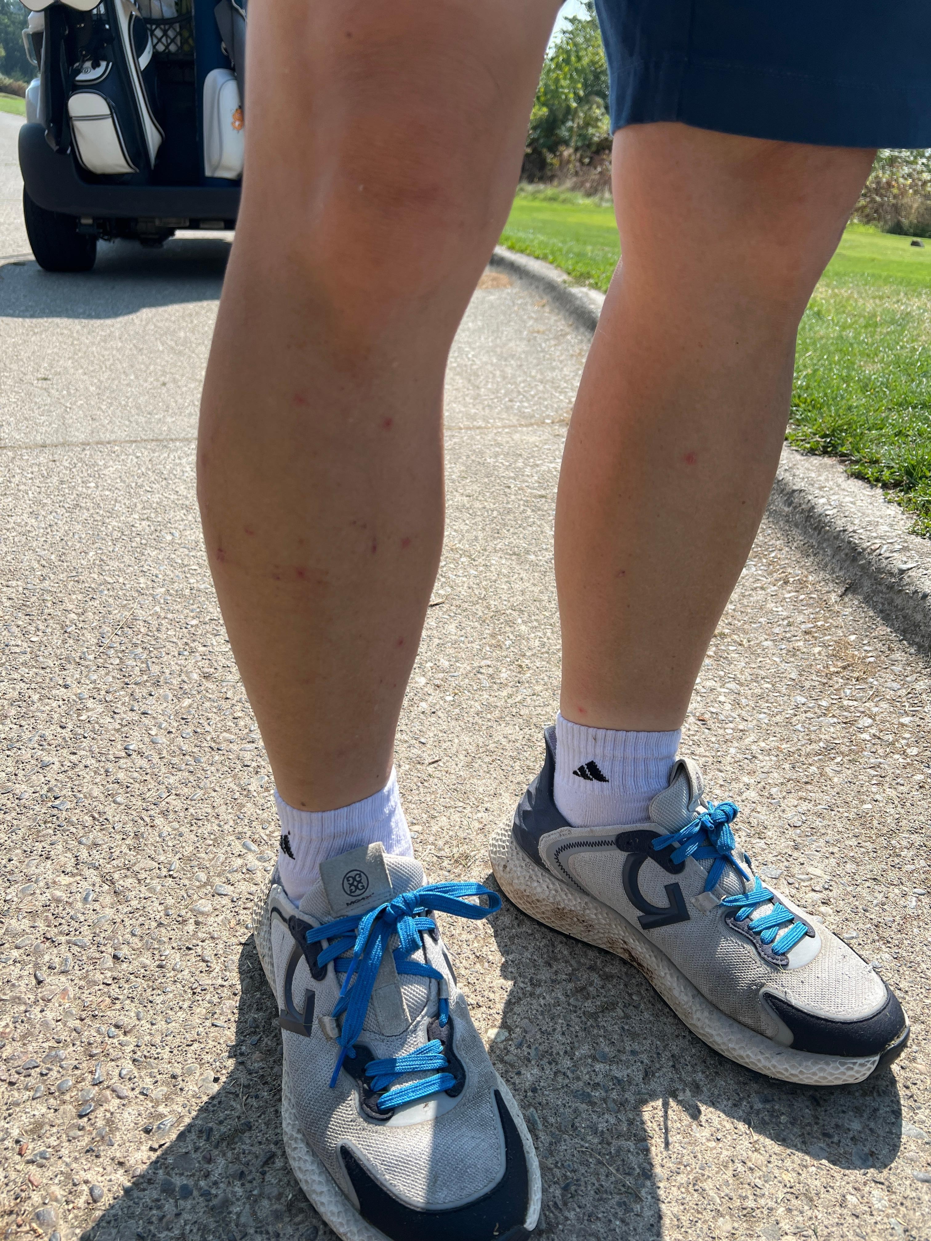 i and my wife were bitten by bed bug on legs and arms with severe itching