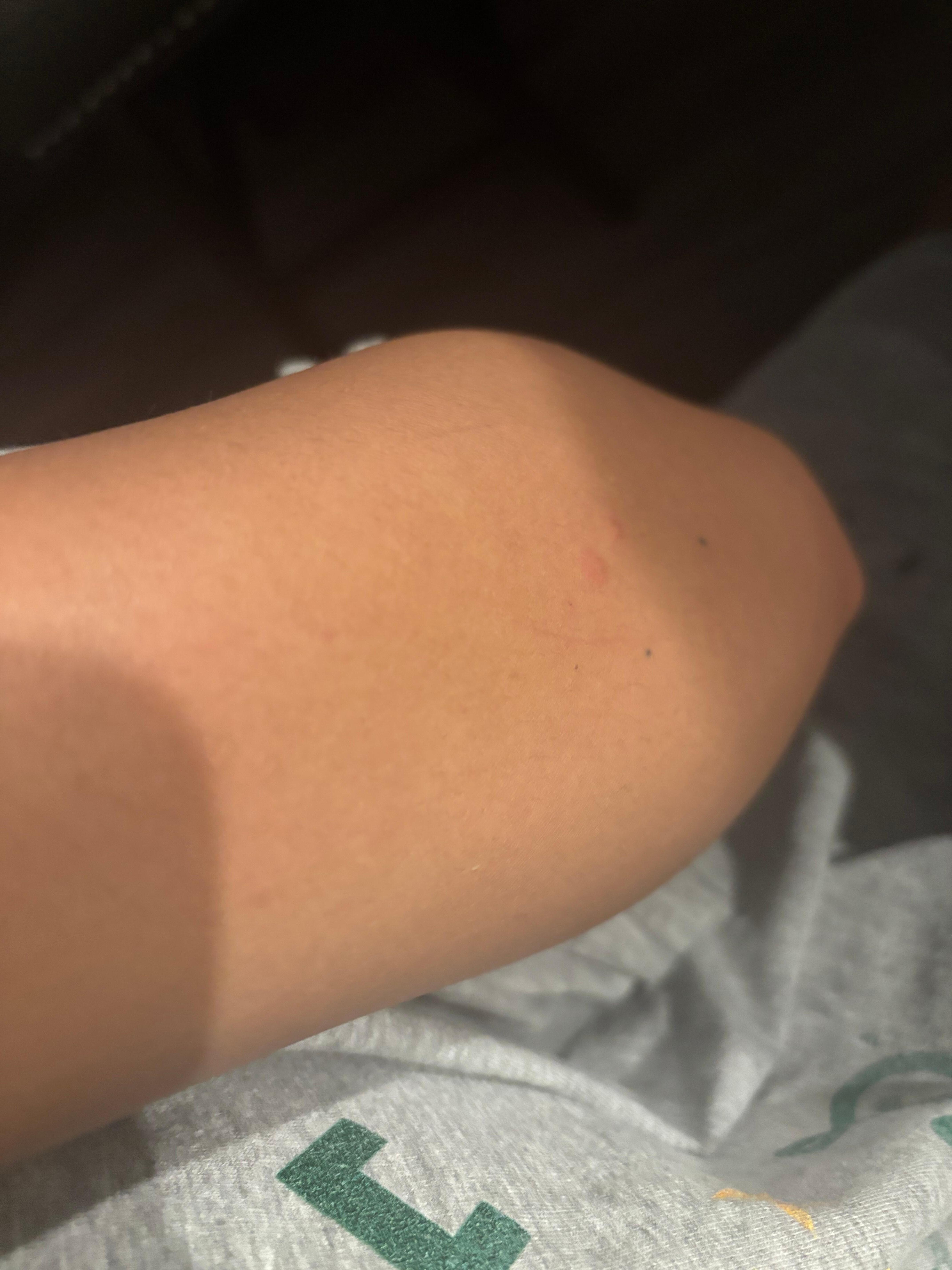 Bed bug bites
