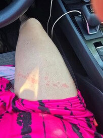 Es evidente que son chinches. Y asi traigo brazo, piernas y espalda.