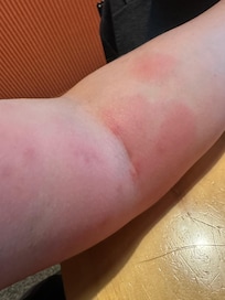 Asi amanecieron mis brazos de la suciedad de la cama, las sabanas, las comidas y las fundas...