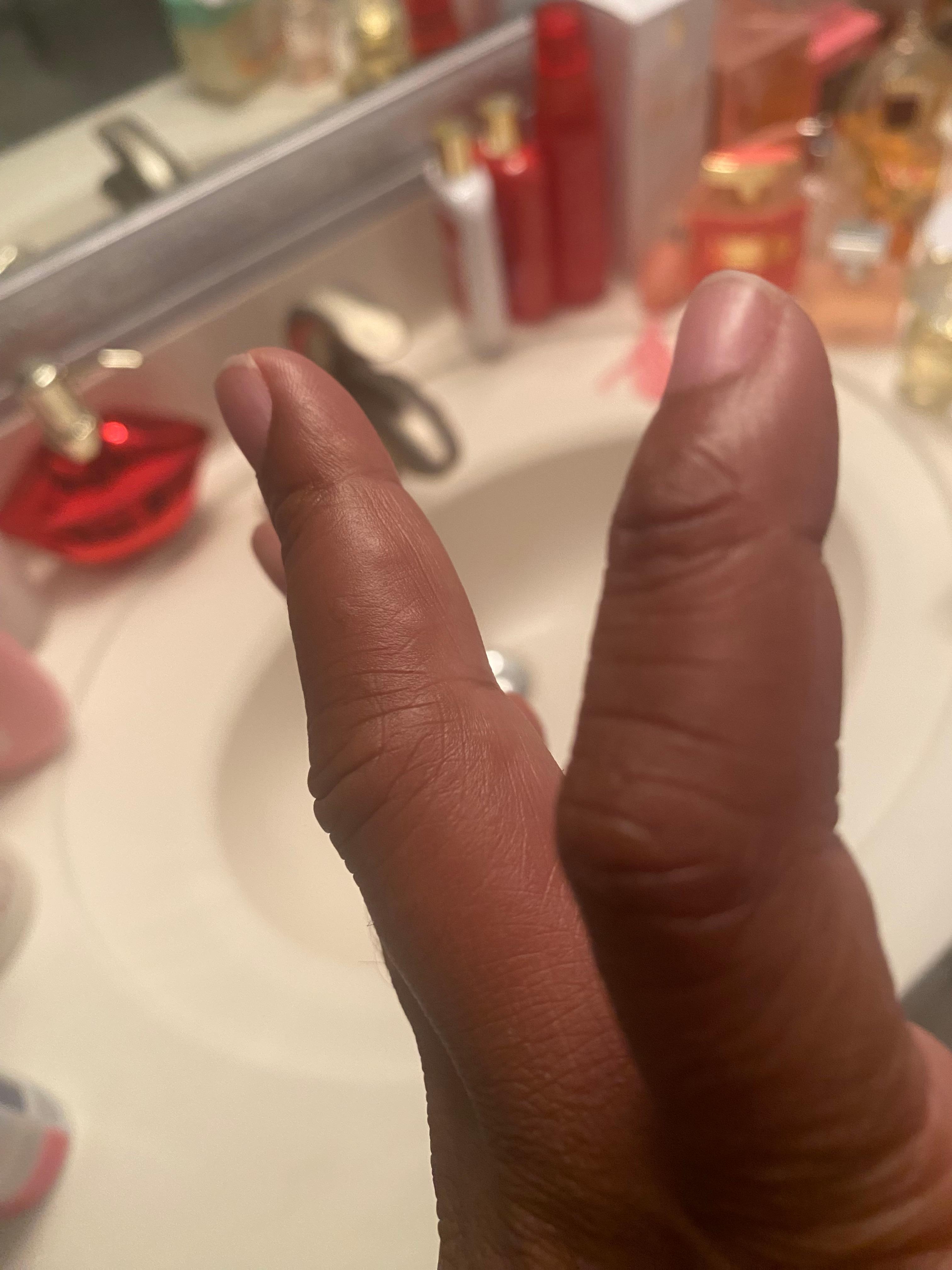 The bites o my finger