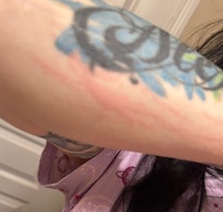 Bed bug bites reaction and