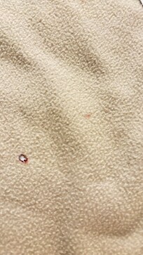 Bed bugs and cigarette burns