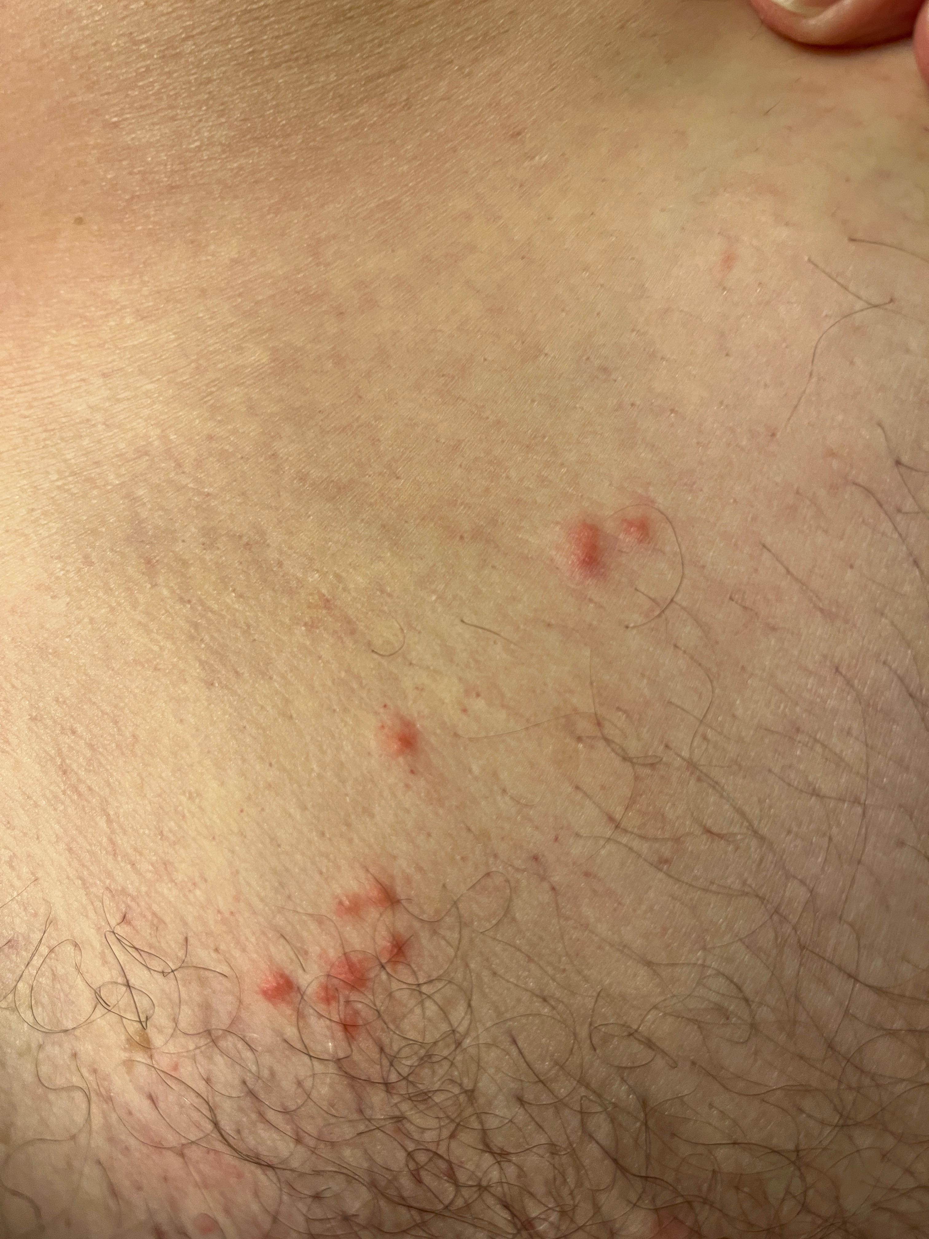 Bug bites