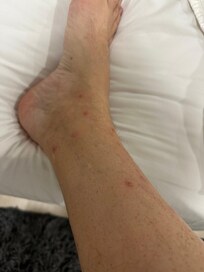 Bed bug bites