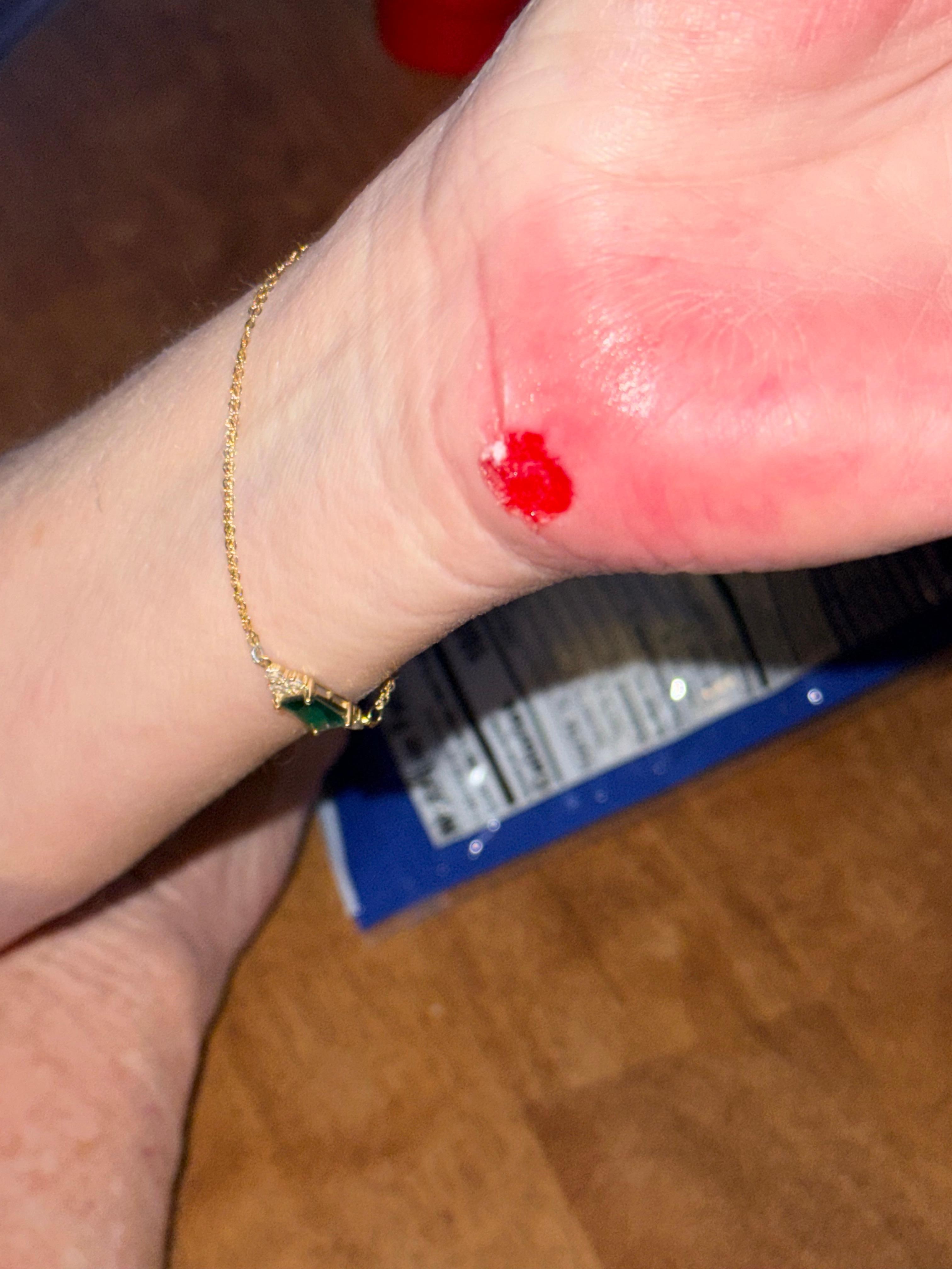 We’re wife fell because of lighting and uneven sidewalk