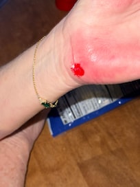 We’re wife fell because of lighting and uneven sidewalk