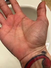 Bed bug bites and reaction on BOTH hands