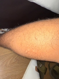 My son's leg after bedbugs bites him