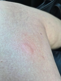 My leg after being bitten by something under the table. Yuck