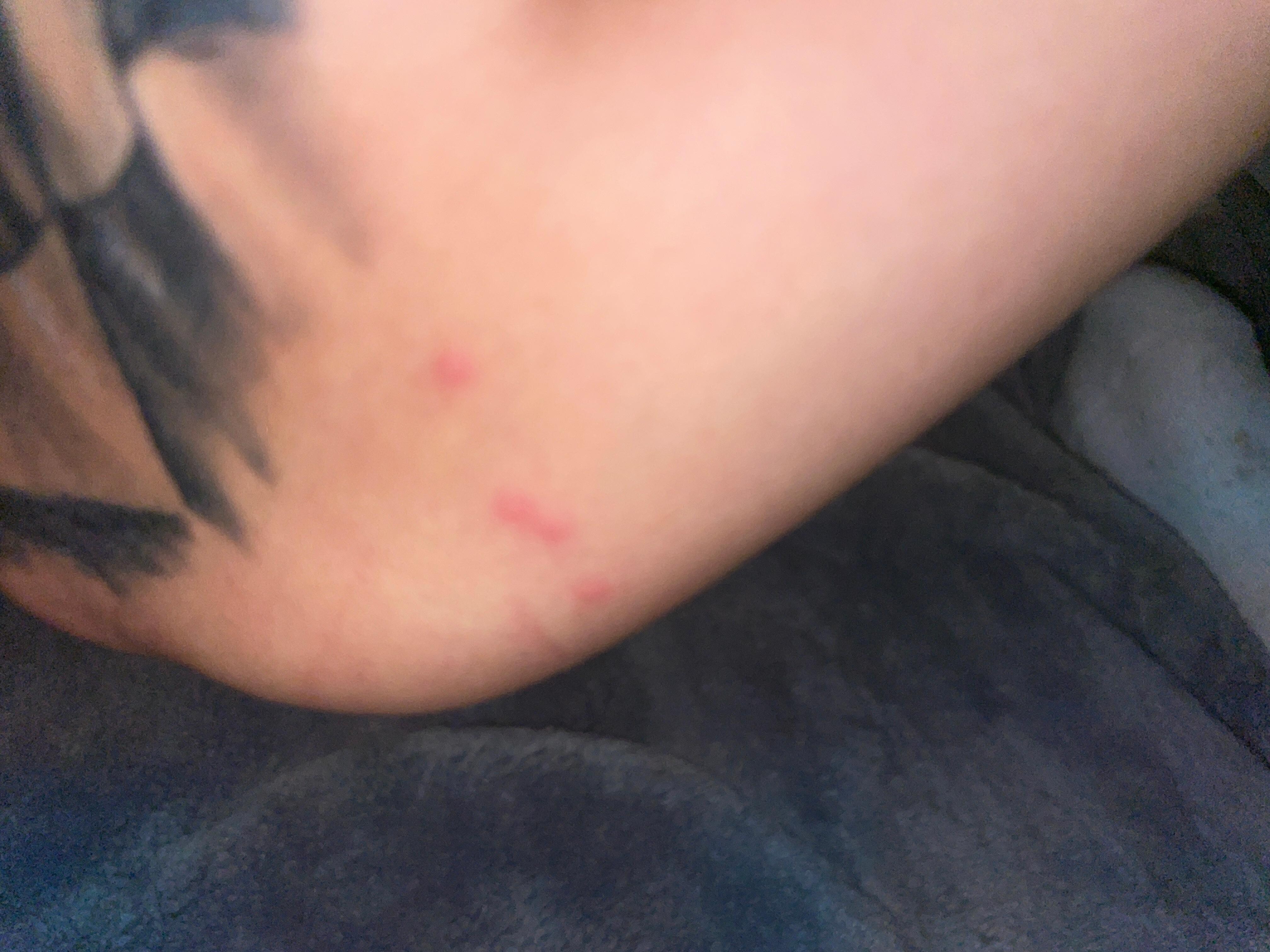 Bug bites from hotel