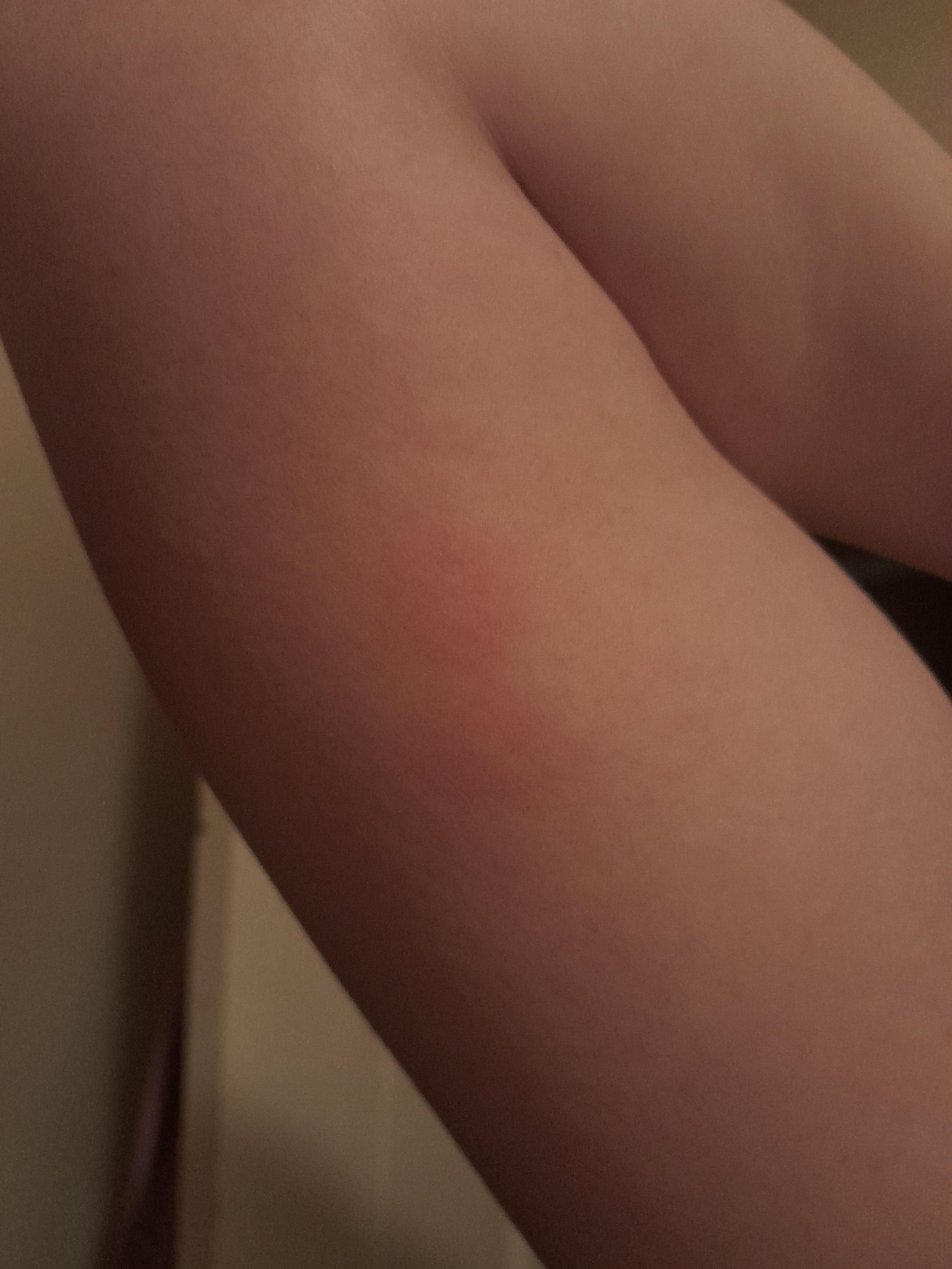 Bedbug bites from the sofa sleeper