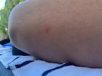 Bedbugs