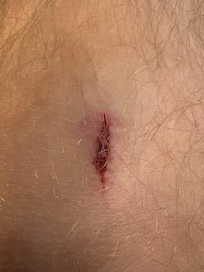 My leg blessure