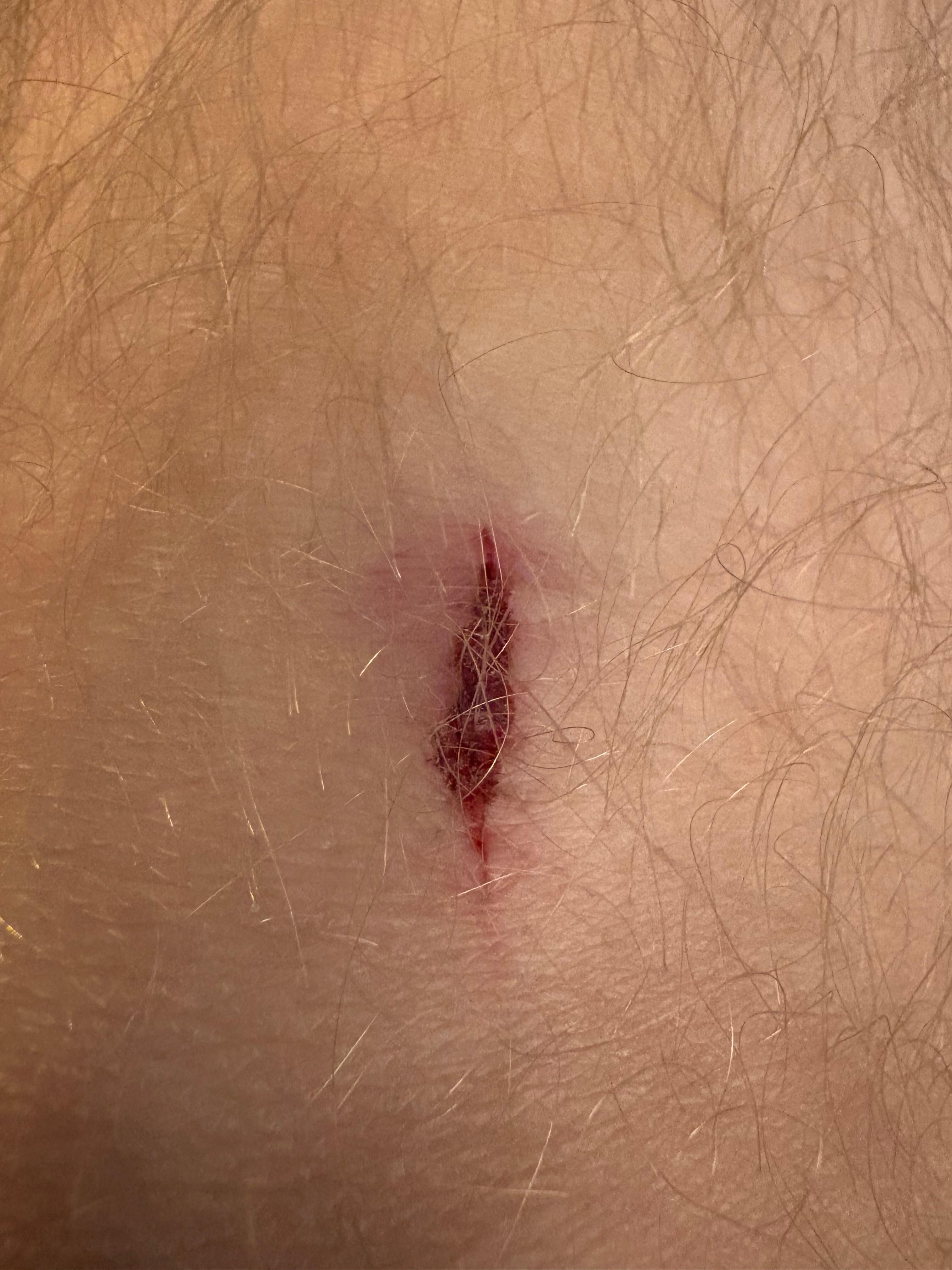 My leg blessure
