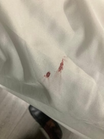 Blood on sheets
