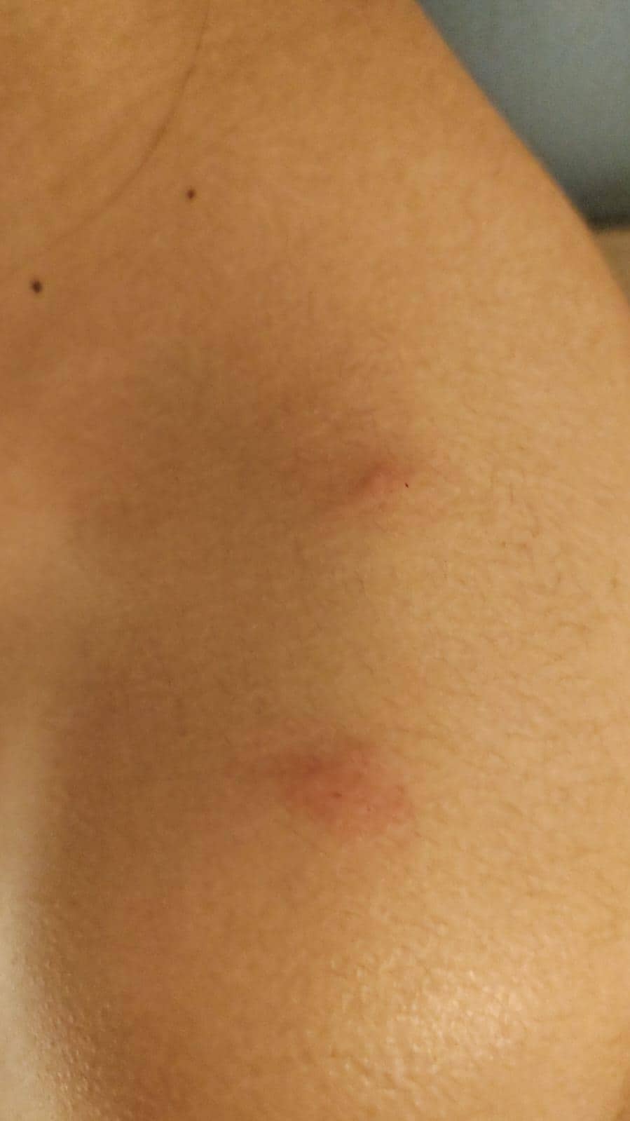 Picadura de chinches en su hotel